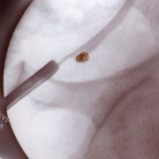 Kidney Stones related image